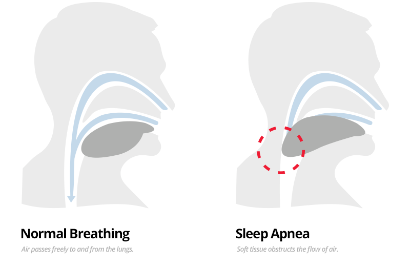 illustration of what is obstructive sleep apnea